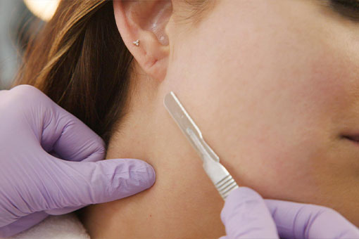 Undergoing dermaplaning can have a number of benefits for the skin