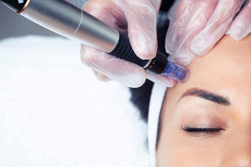 The microneedling device has a unique mechanism to allow precise control for the aesthetician