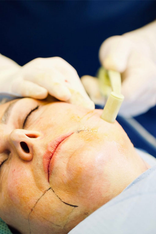 Accutite skin tightening