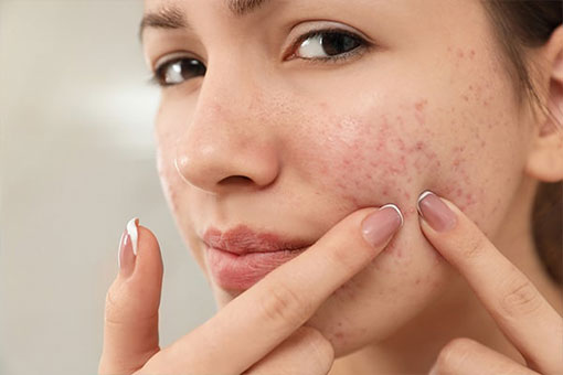 Acne scarring