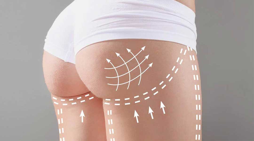 Tighten and firm your buttocks to give a smoother and softer appearance