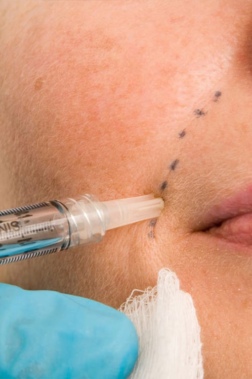 Dermal fillers