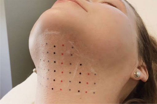 Fat dissolving injections for the face