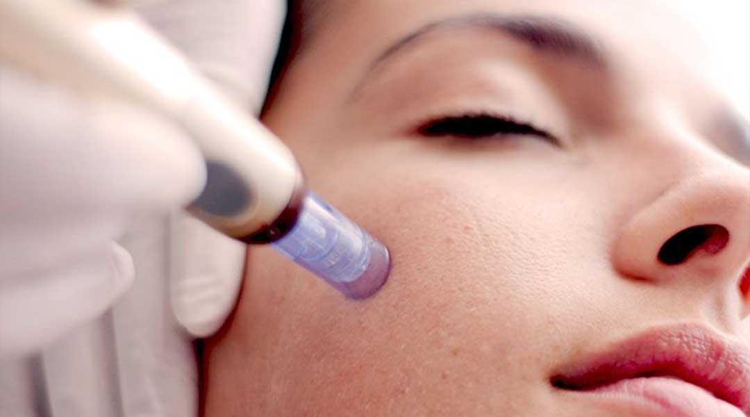 Microneedling treatments are a perfect way to improve the texture of the skin