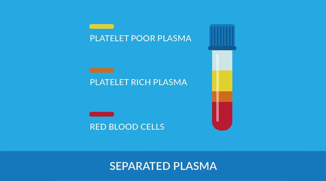 Diagram showing the separation of platelet rich plasma from the rest of the blood