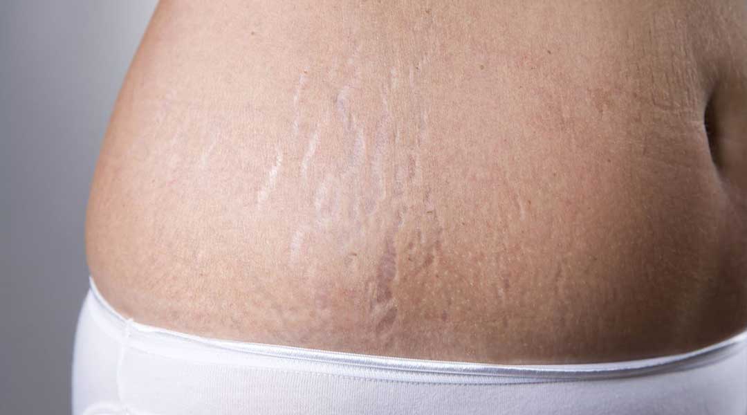 Stretch marks can cause issues with body confidence