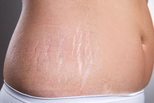 Microneedling for stretch marks