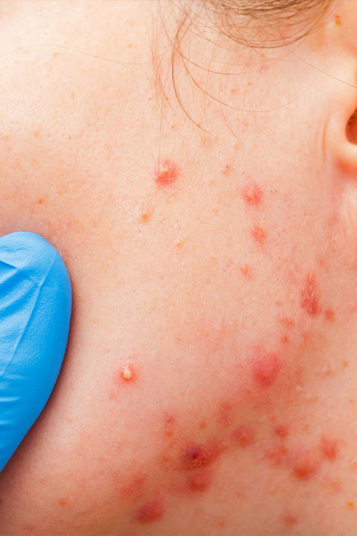 Acne is characterised by red or white lumps on the skin