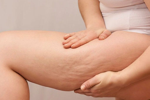 Cellulite reduction treatments