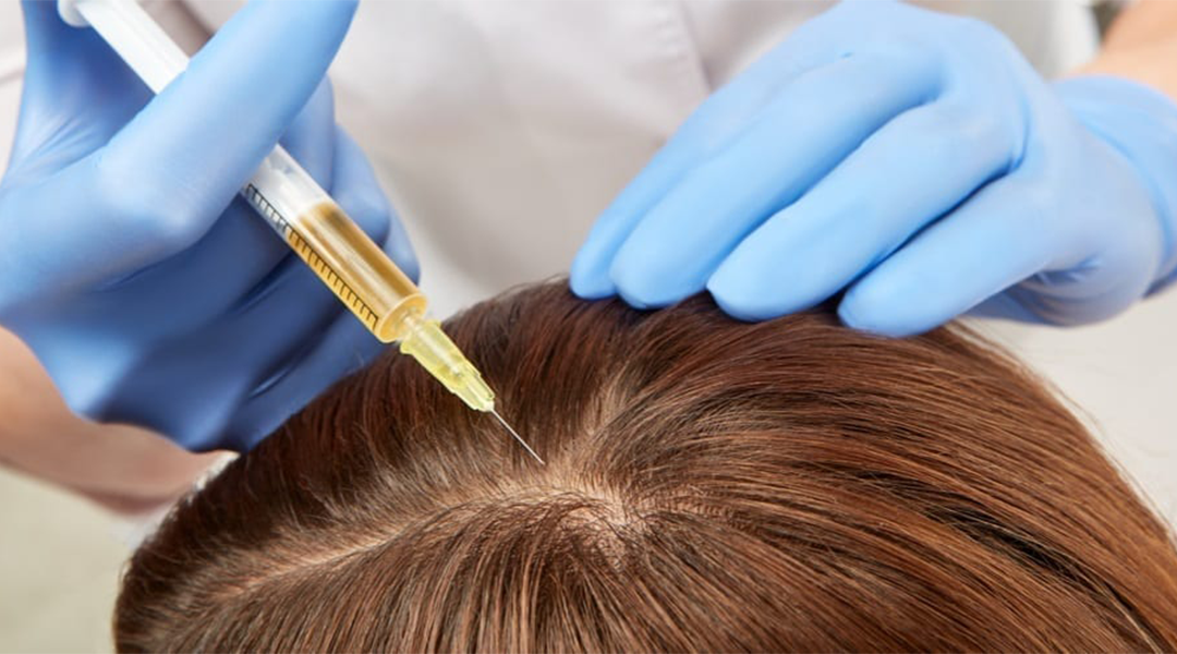 How Long Does It Take For Platelet Rich Plasma Hair Therapy To Work?