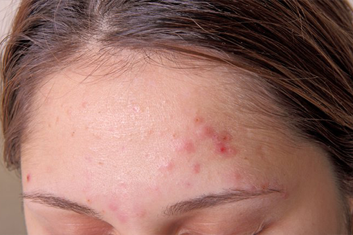 Treatments for acne