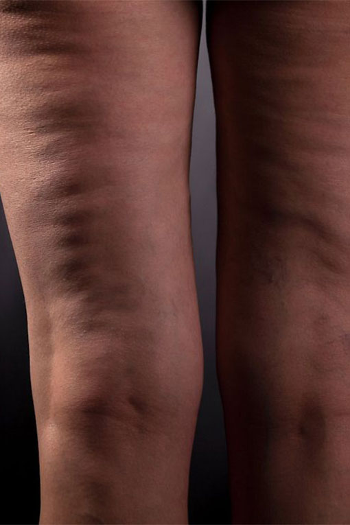 Cellulite is a condition that affects the skin