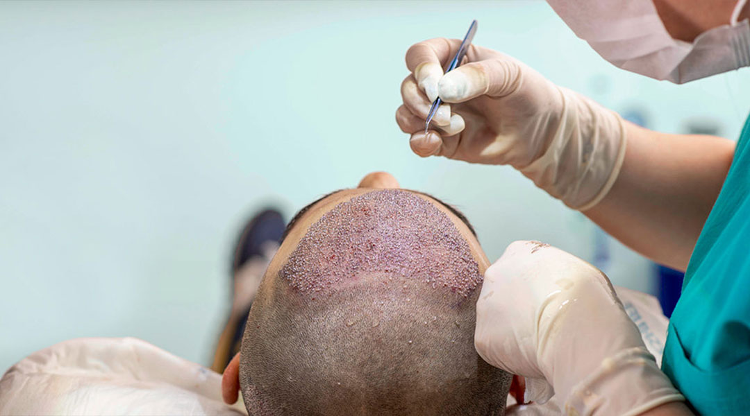 Hair transplant surgery