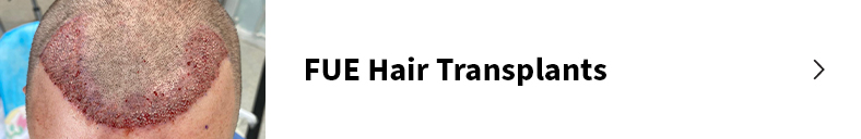 FUE hair transplants