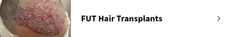 FUT hair transplants