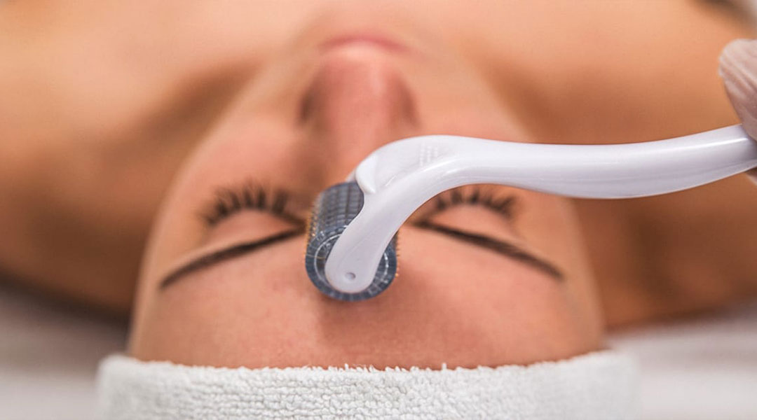 Microneedling treatments