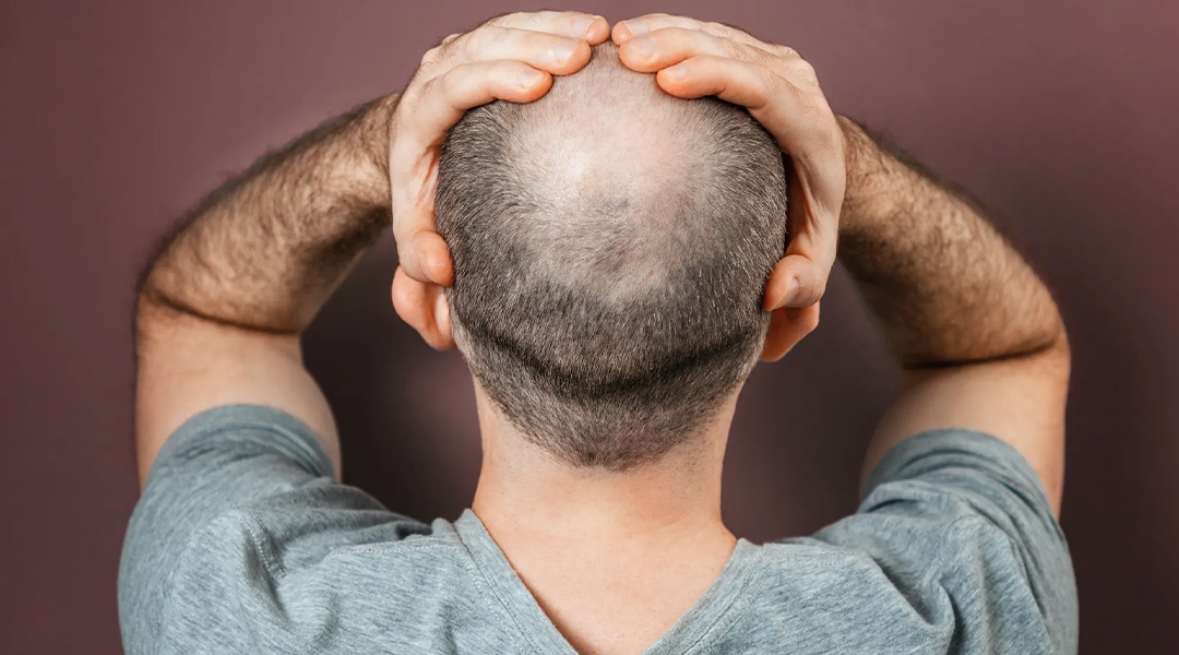 Hair loss in men