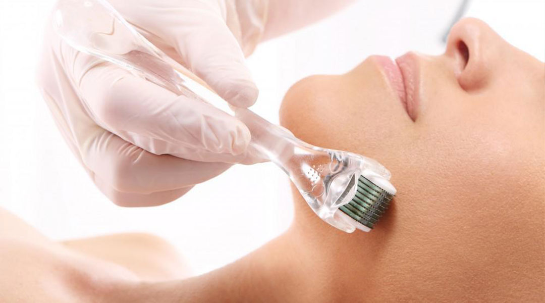 Microneedling treatment