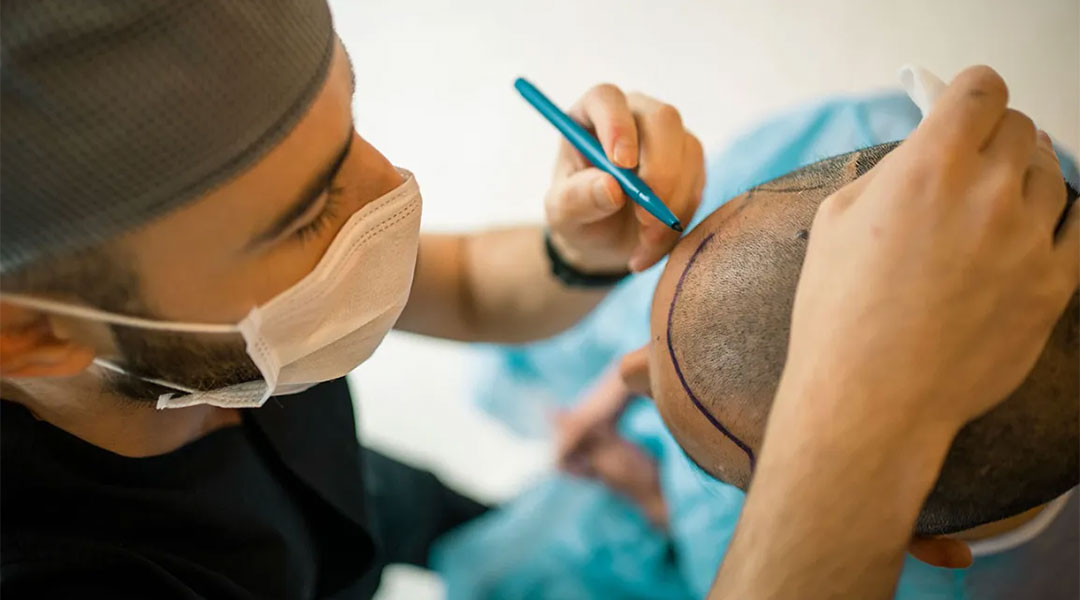 Hair transplant surgery