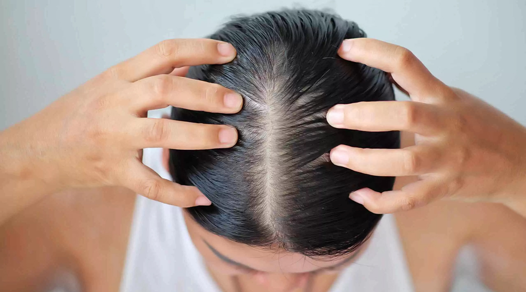 Hair loss in women