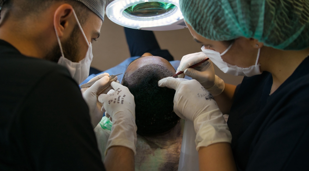 Hair transplant