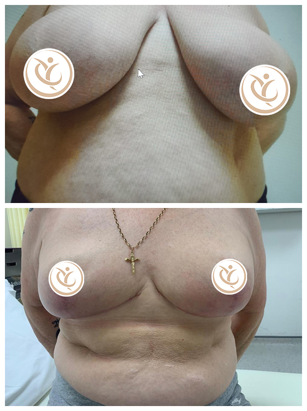 Breast uplift