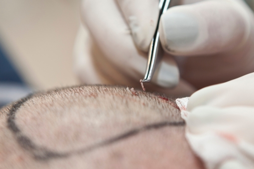 FUE hair transplantation