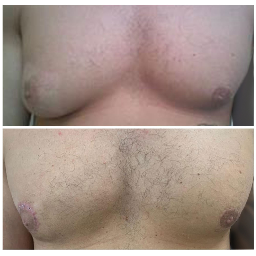 Breast uplift surgery