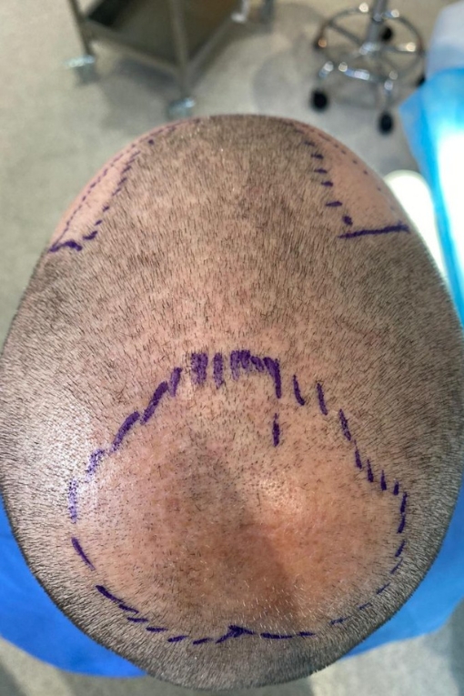 FUE hair restoration