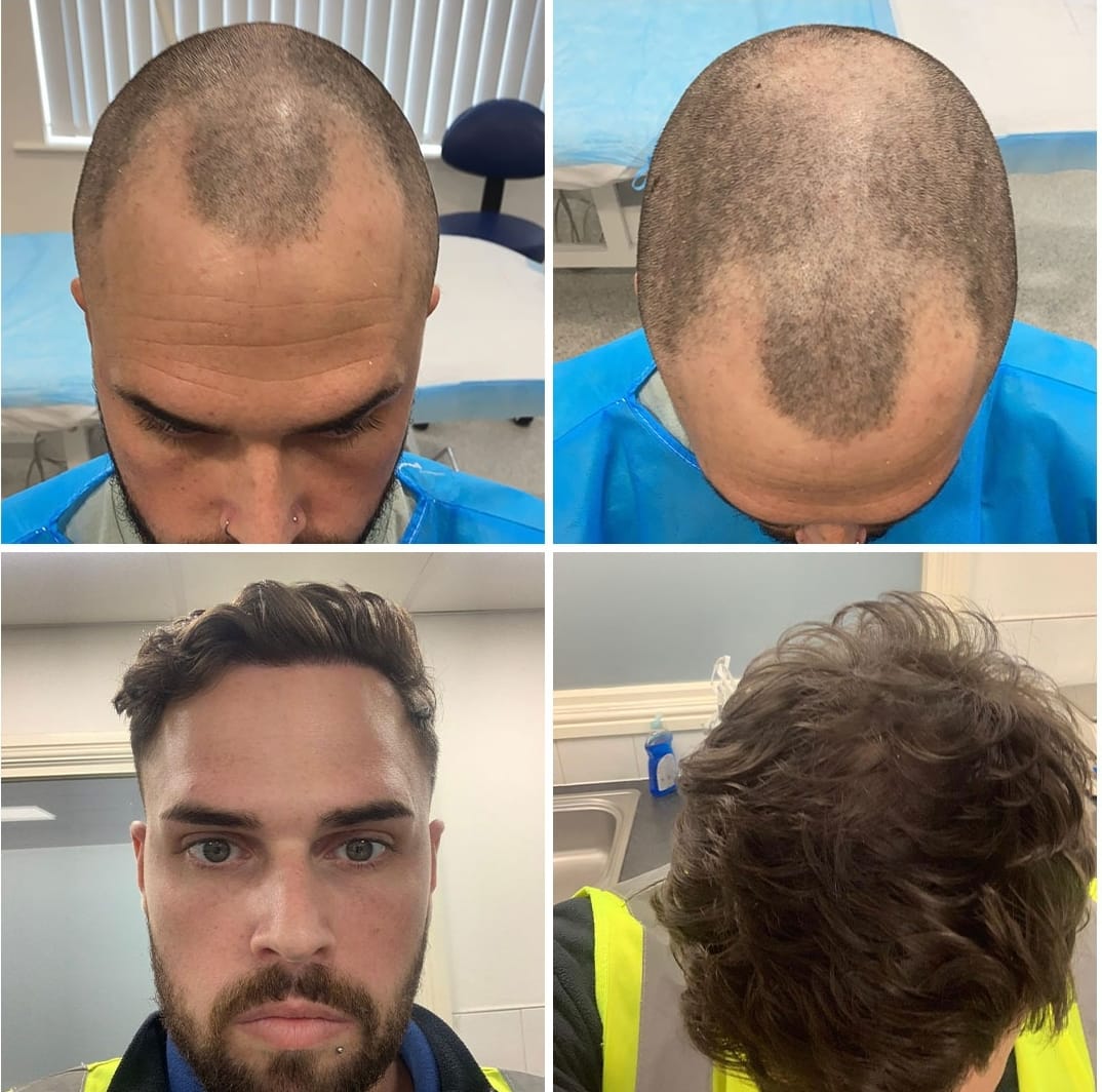 FUE hair restoration