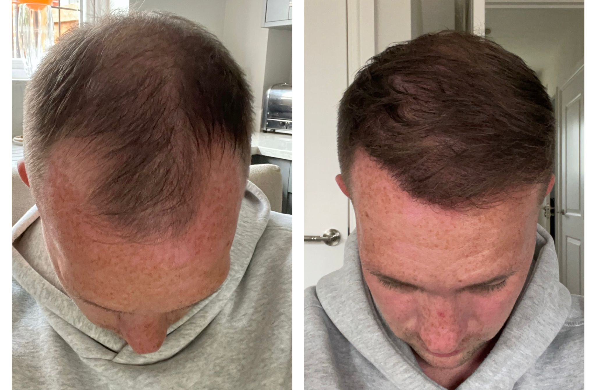 FUE hair restoration