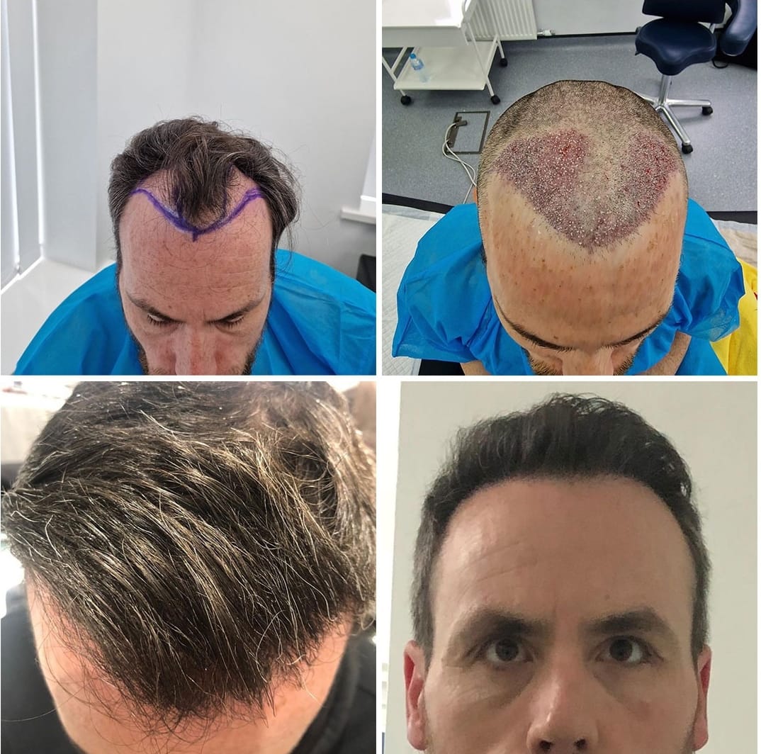 FUE hair transplant