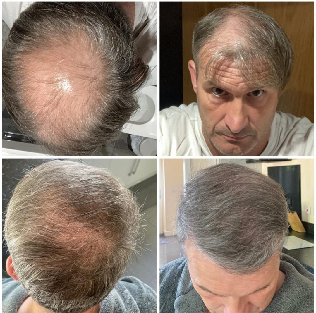 FUE hair transplant