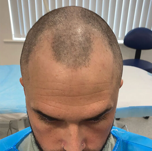 Before A